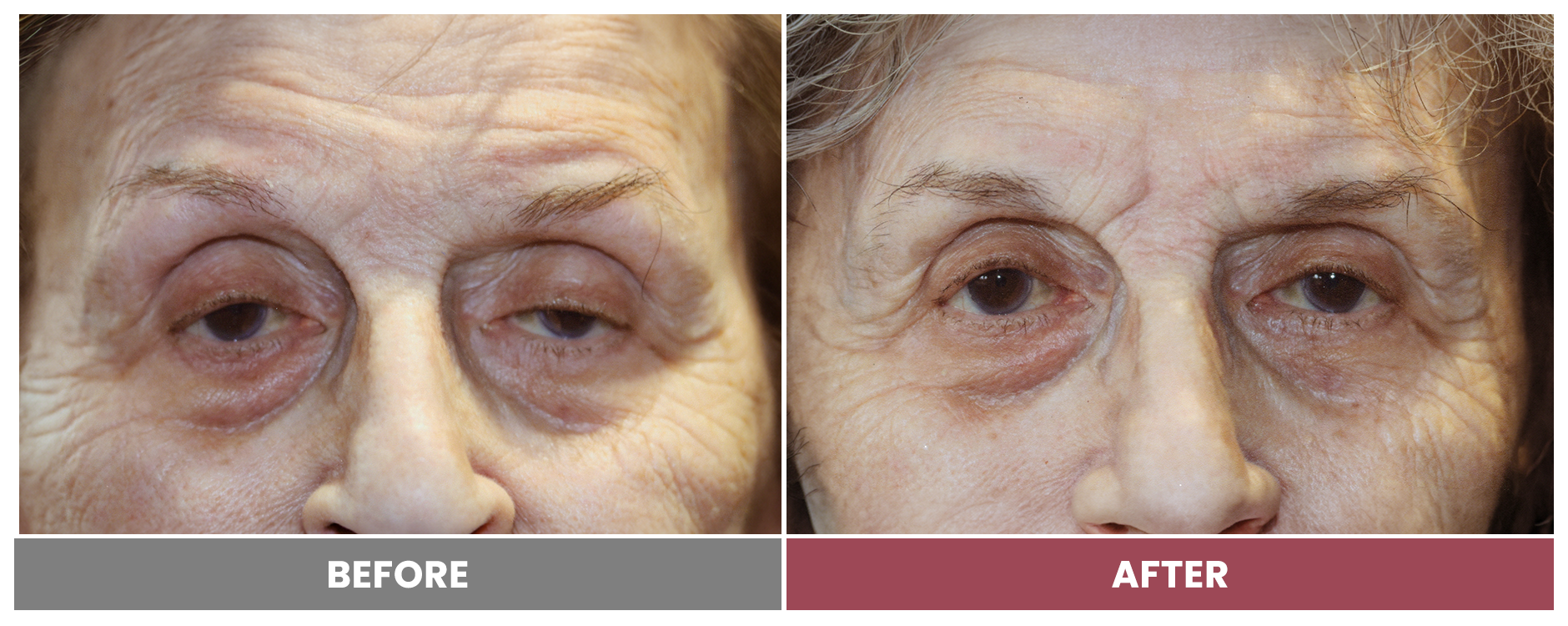 PTOSIS REPAIR - Case 27